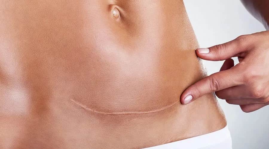 Kiedy do fizjoterapeuty po cc? Kluczowe informacje dla Twojego zdrowia