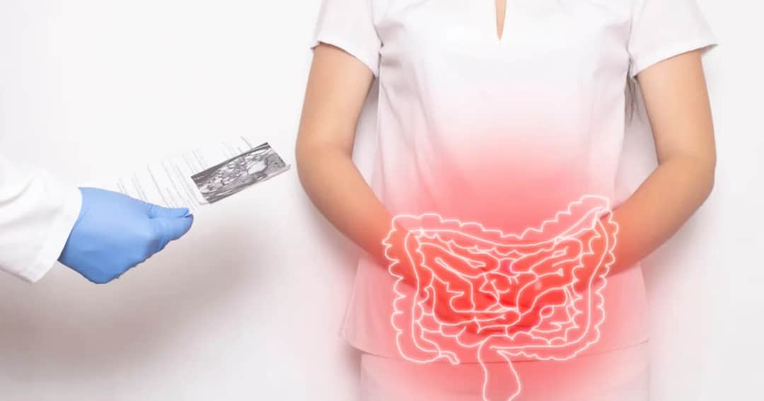 Jakie leki na uchyłki jelita grubego mogą pomóc w leczeniu?