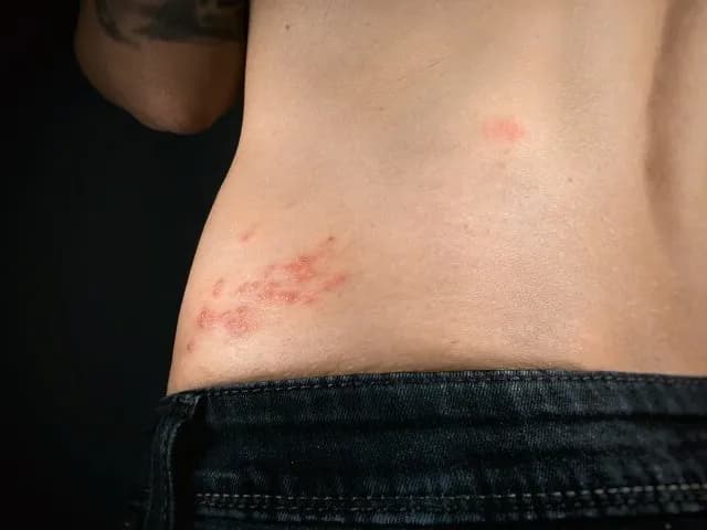 Jak długo brać leki na półpasiec, aby uniknąć długotrwałego bólu?